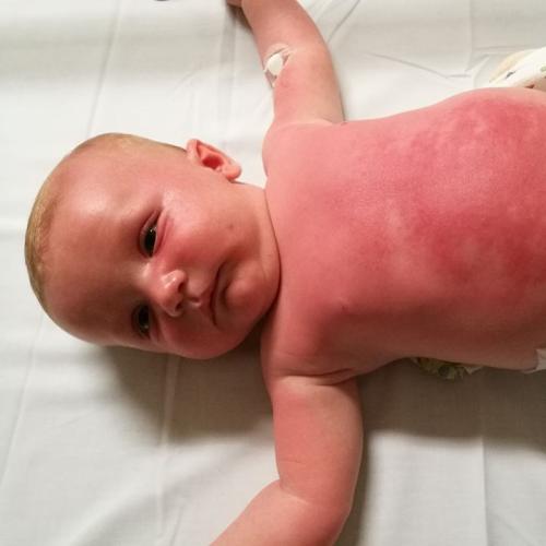Popular Sunscreen “Burnt” Baby’s Skin