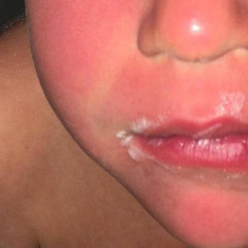 Popular Aussie Sunscreen Brand Slammed Over Horrific Burns